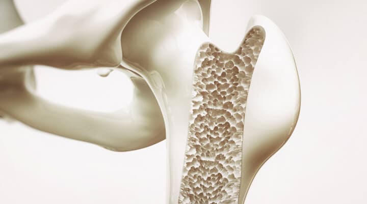 osteoporoza